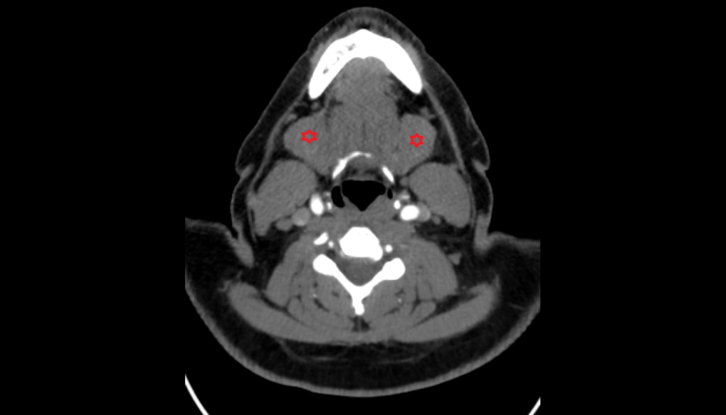 Submandibular gland CT axial  image-img-00000-00000