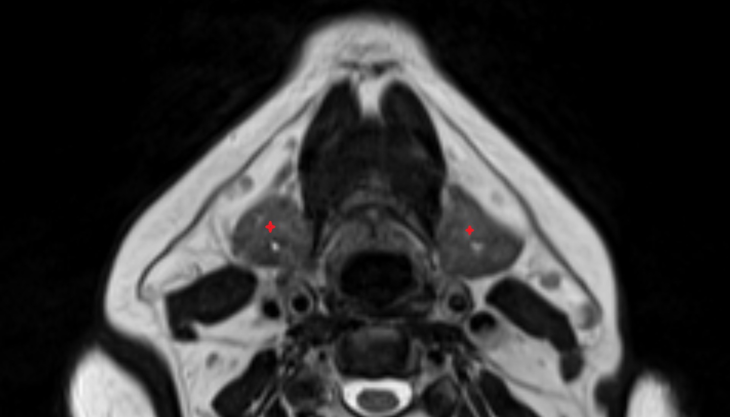 Submandibular gland  mri axial image -img-00000-00000