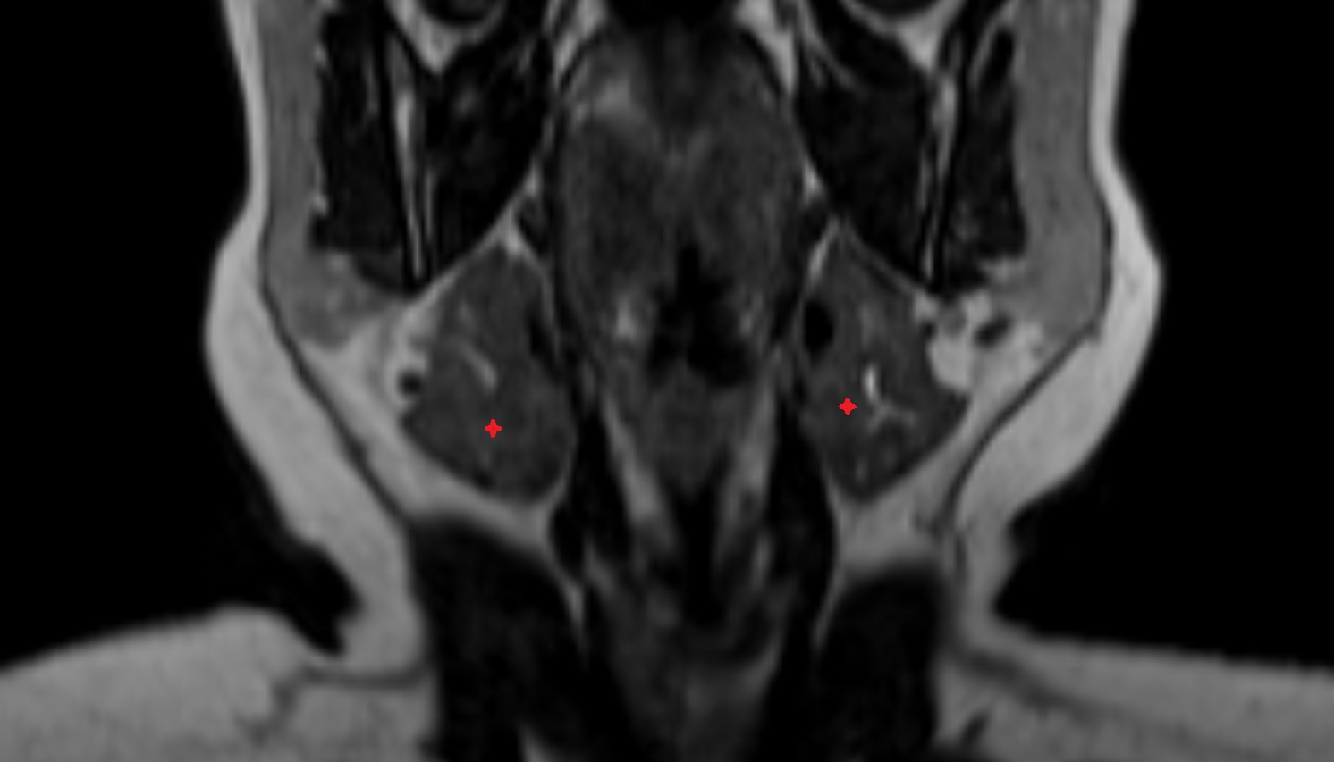 Submandibular gland  mri coronal image -img-00000-00000