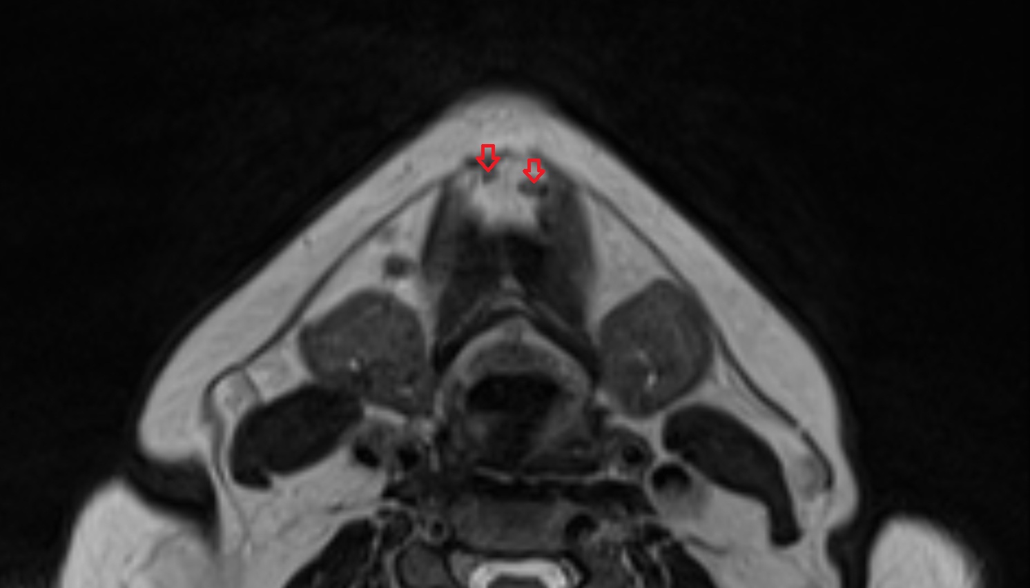 Submental Lymph Nodes  mri axial  image -img-00000-00000