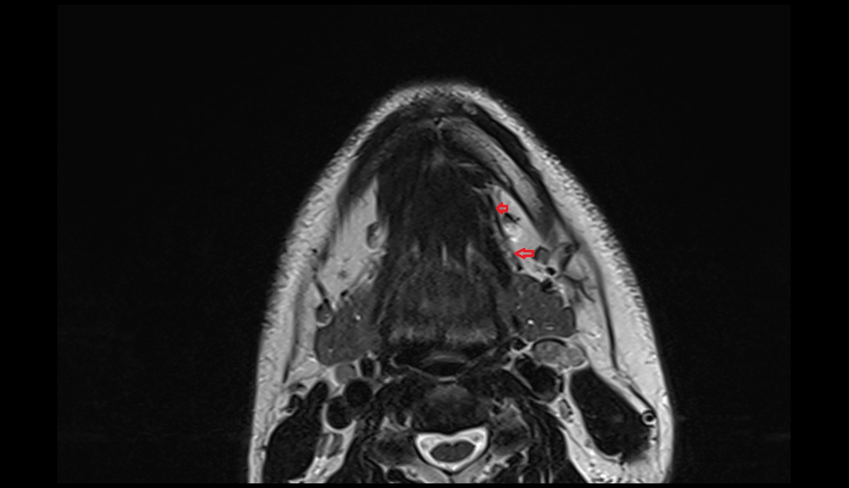 Submental Vein mri image