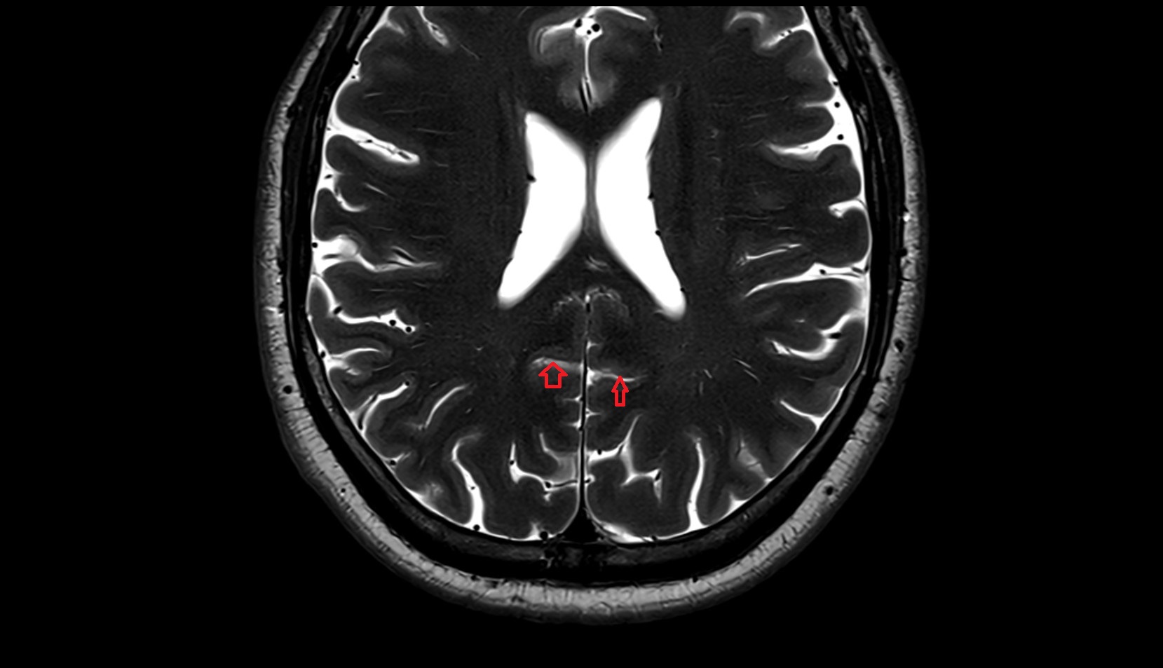 Subparietal sulcus MRI 3T axial image