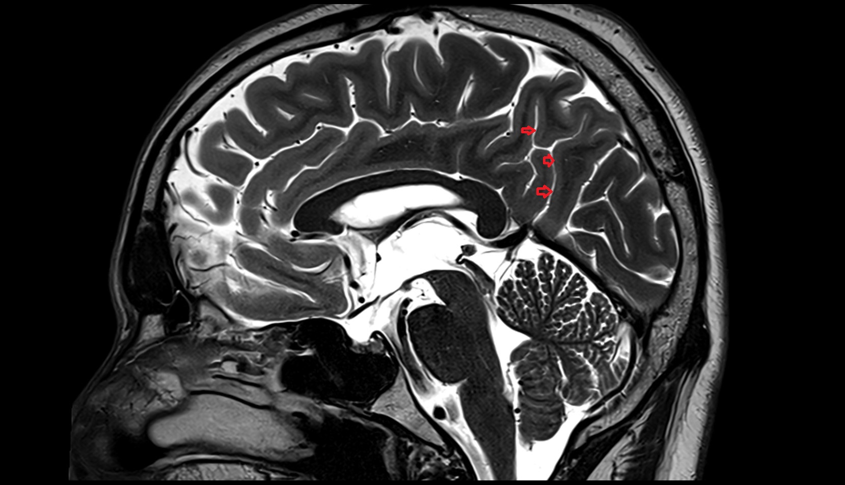 Subparietal sulcus MRI 3T sagittal image