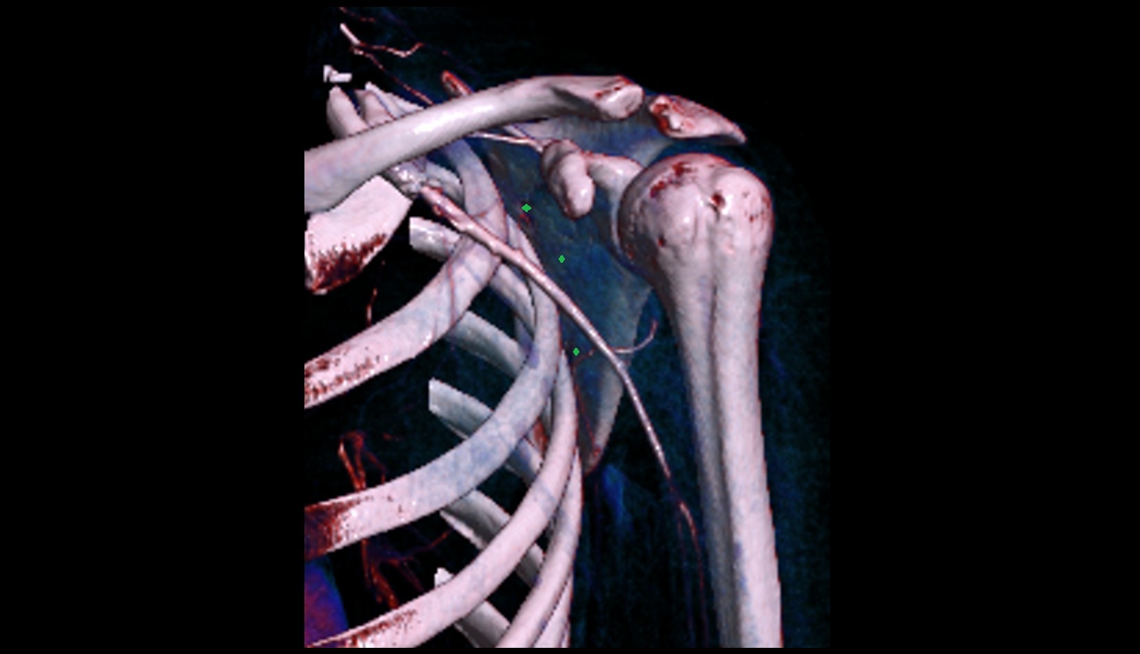 Subscapular fossa 3d vrt image