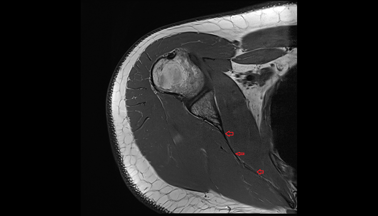 Subscapular fossa of scapula axial cross sectional anatomy 3T MRI AI enhanced radiology image-img-00000-00000