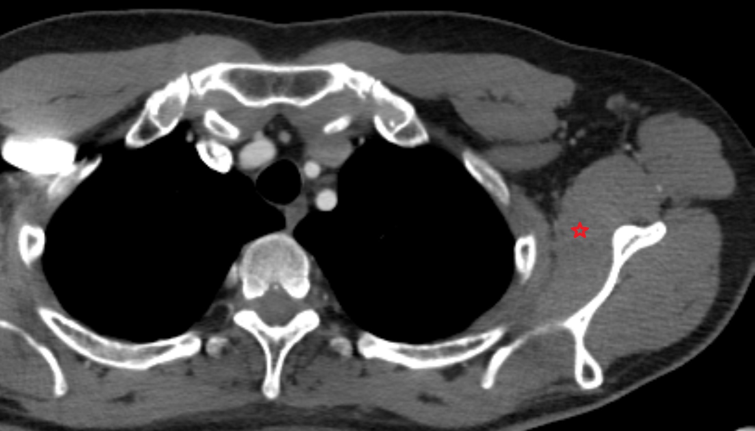 Subscapularis muscle  anatomy ct coronal  image -img-00000-00000