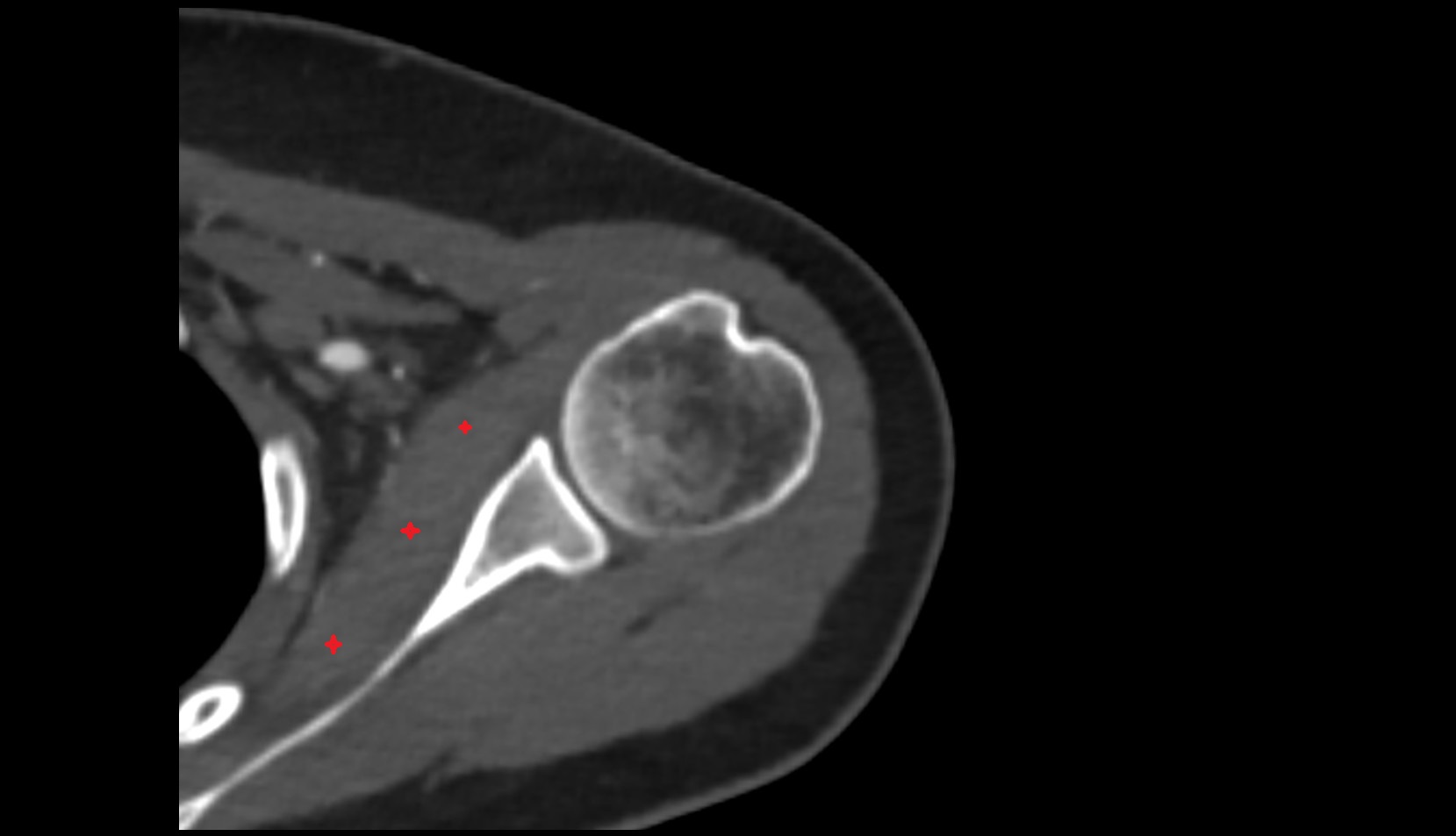 Subscapularis muscle ct axial