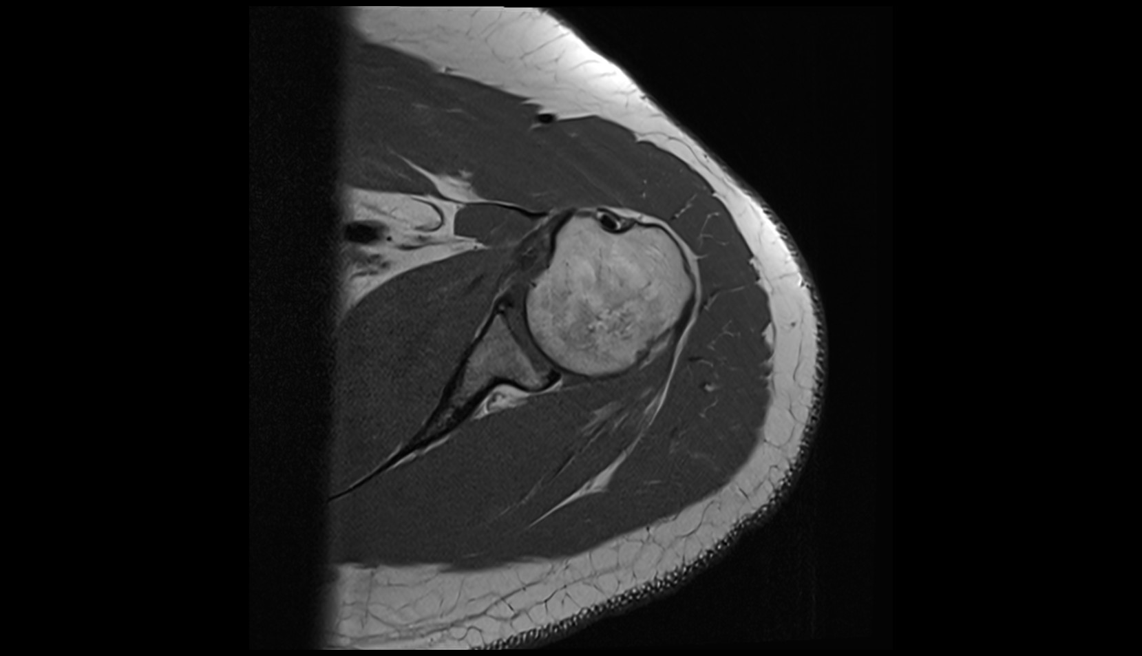 Subscapularis muscle mri AXIAL IMAGE