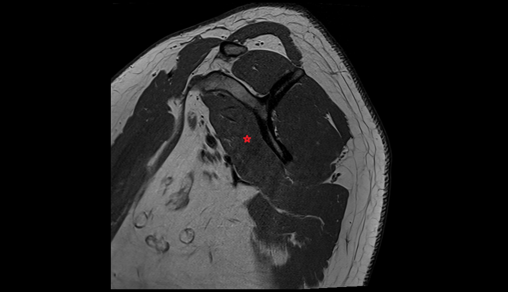 Subscapularis muscle mri sag image