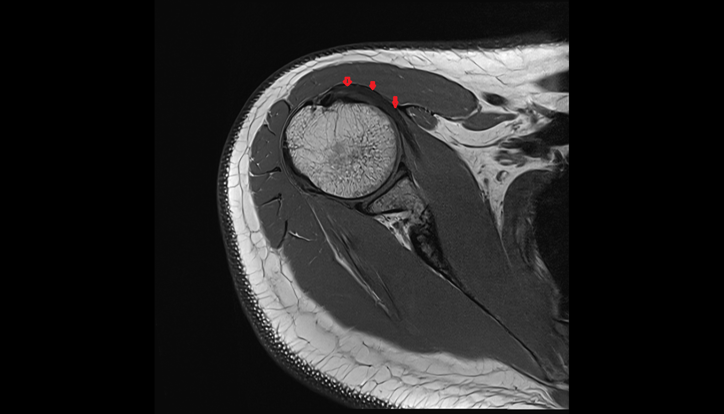 Subscapularis tendon axial cross sectional anatomy 3T MRI AI enhanced radiology image-img-00000-00000