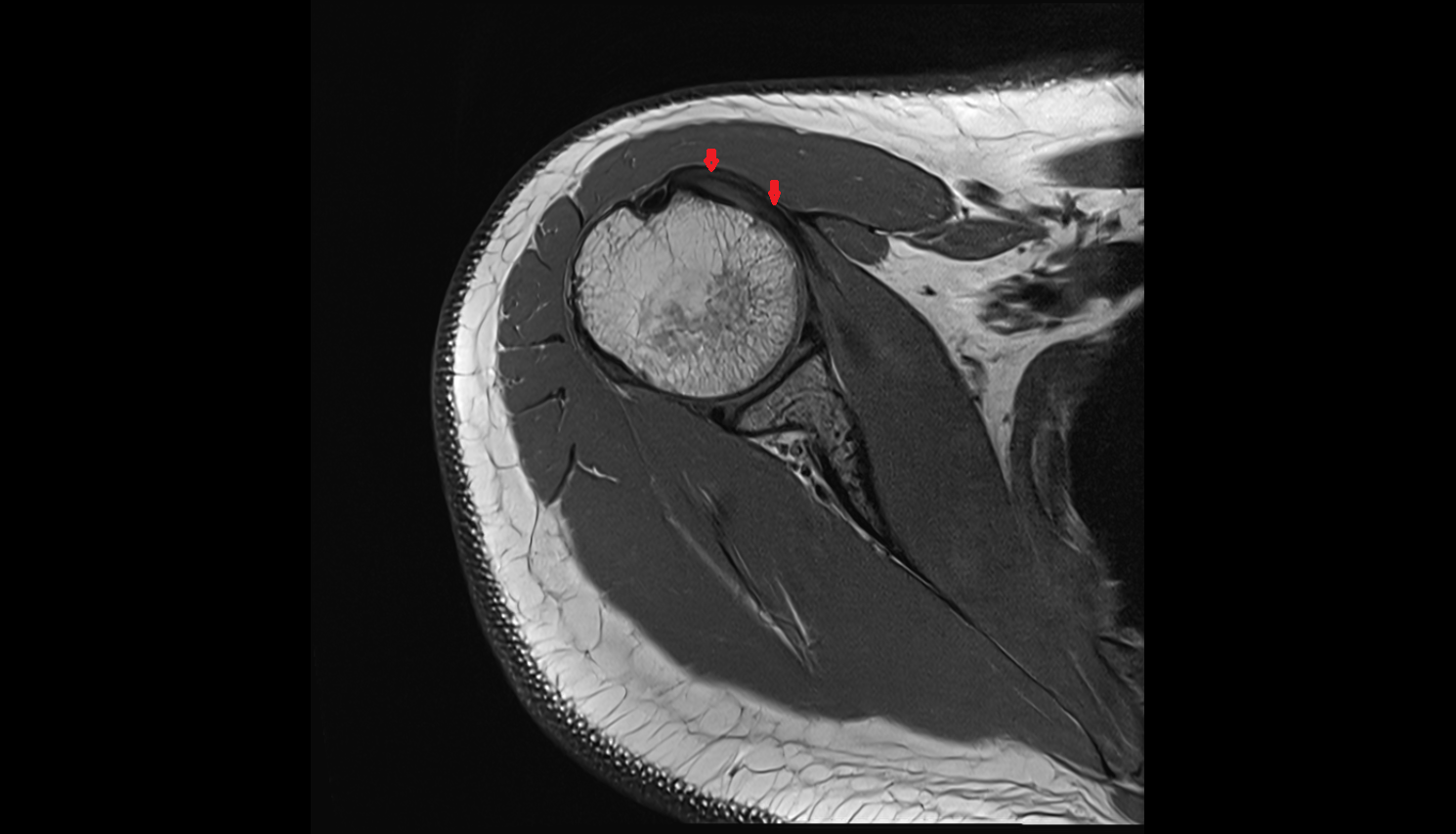 Subscapularis tendon axial cross sectional anatomy 3T MRI AI enhanced radiology image-img-00000-00000_00001