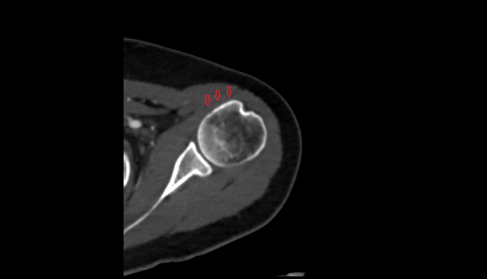 Subscapularis tendon ct axial
