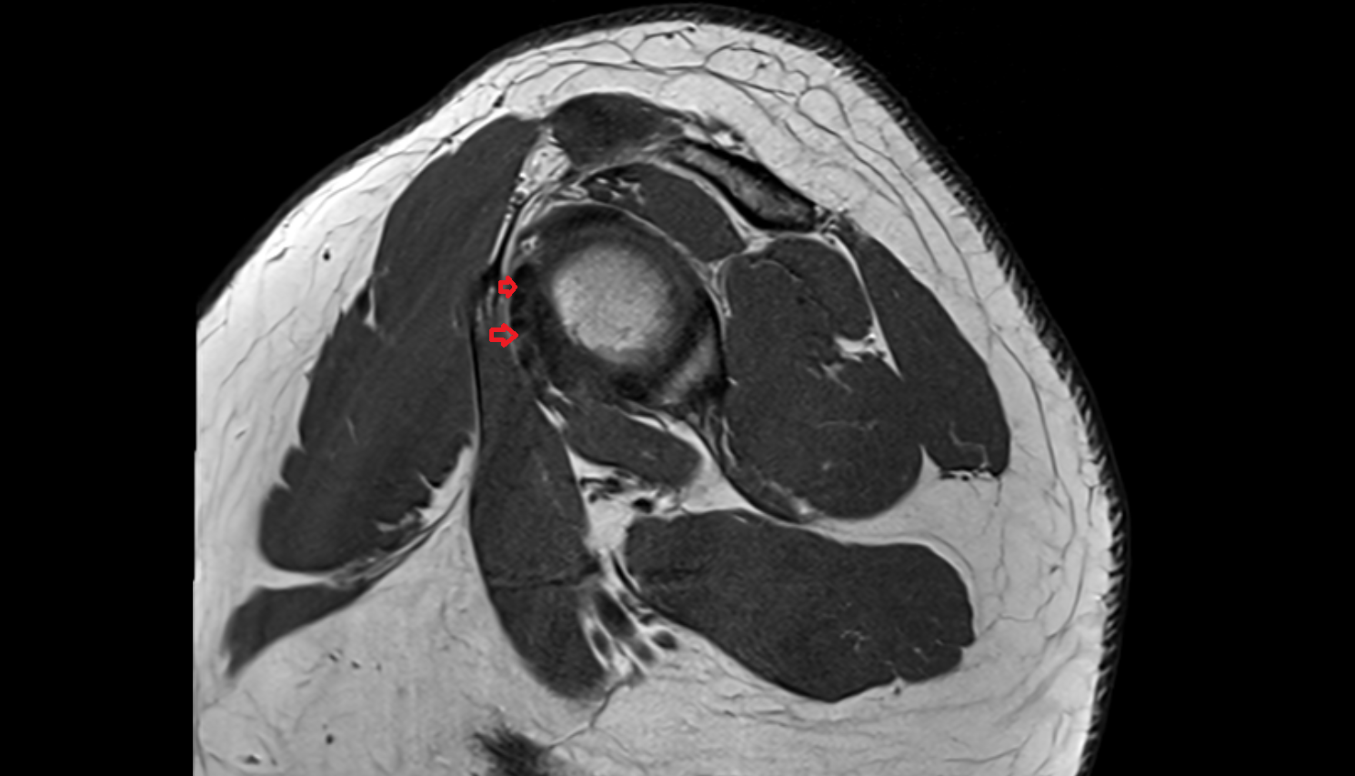 Subscapularis tendonsagl cross sectional anatomy 3T MRI AI enhanced radiology image-img-00000-00000