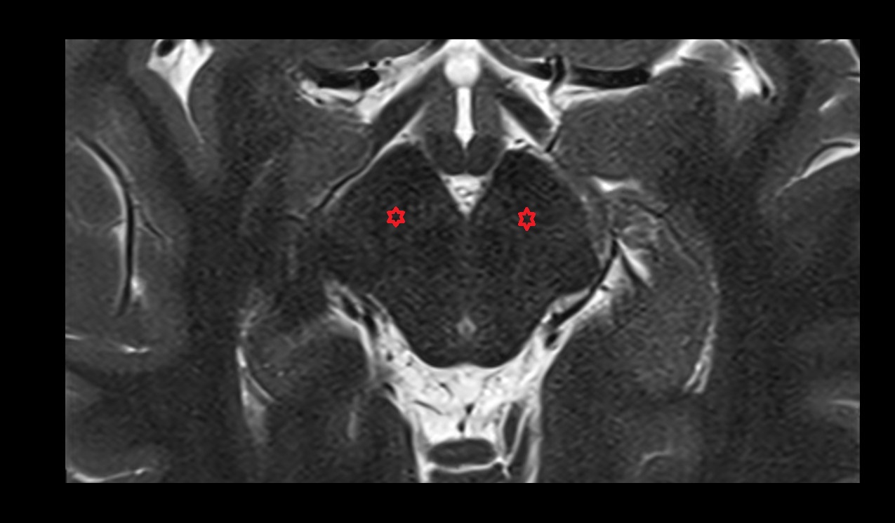 Substantia nigra mri 3t axial image