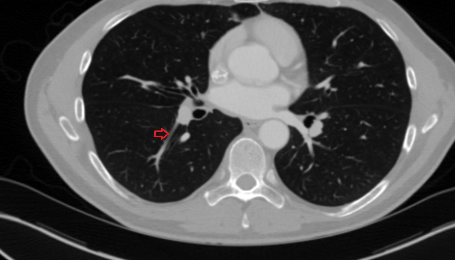 Subsuperior segmental artery of right lung   anatomy CT axial  image -img-00000-00000