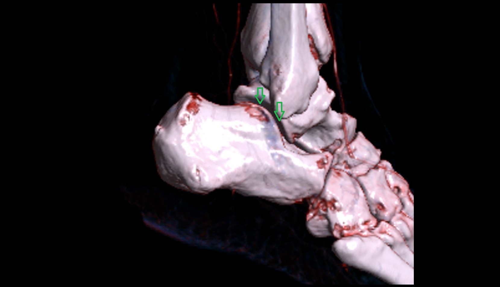 Subtalar joint 3d