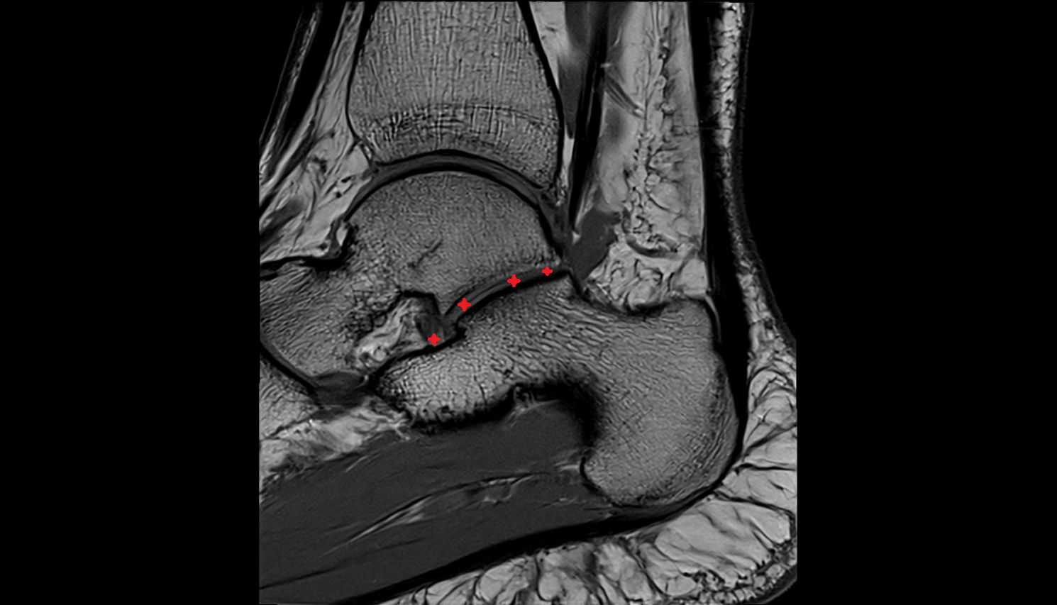 Subtalar joint  mri  anatomy labelled image-img-00000-00000