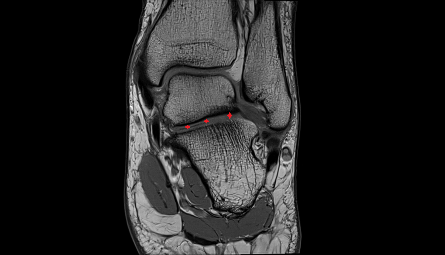 Subtalar joint  mri  anatomy labelled image-img-00000-00000_00001