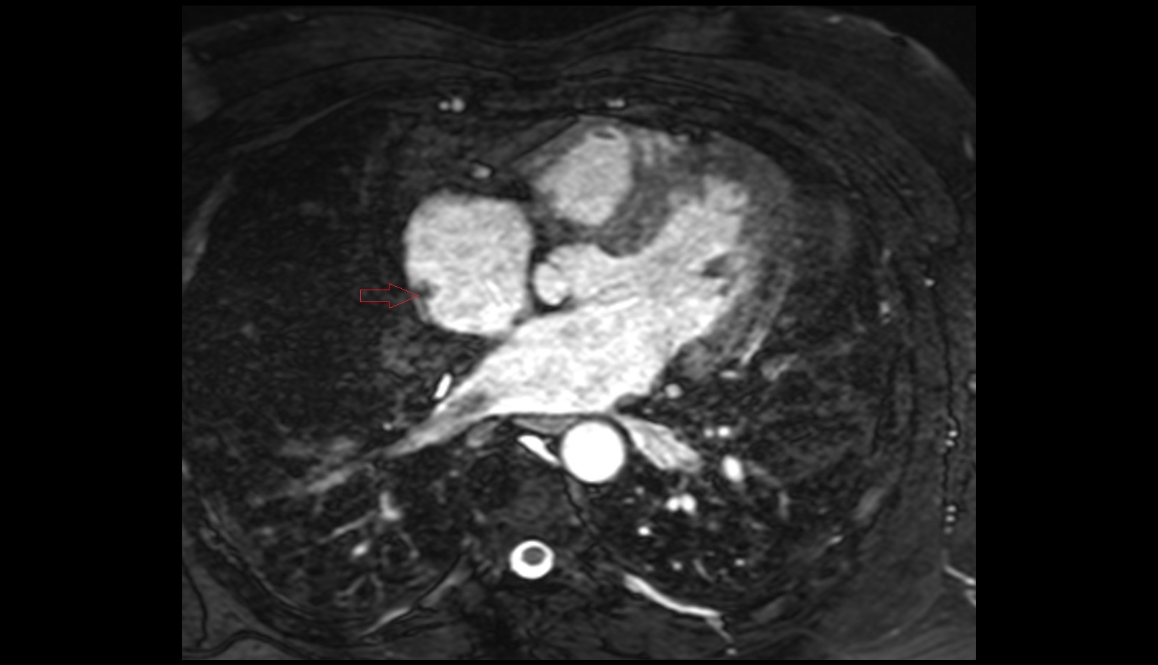 Sulcus terminalis of heart mri axial image