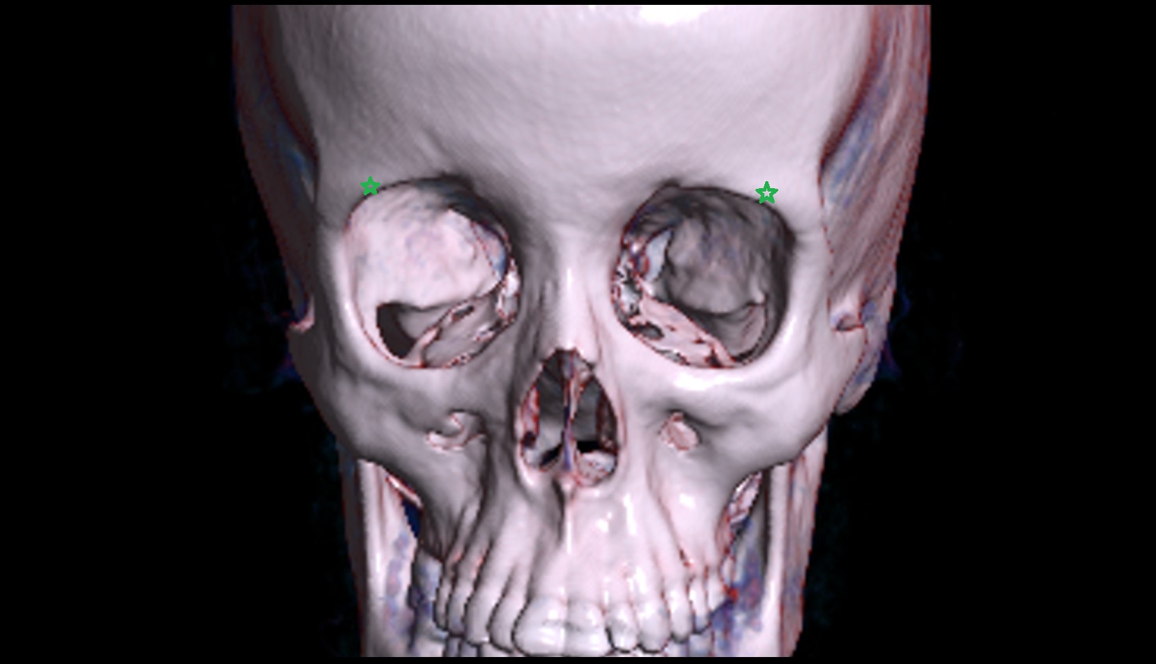 CT Superciliary arch