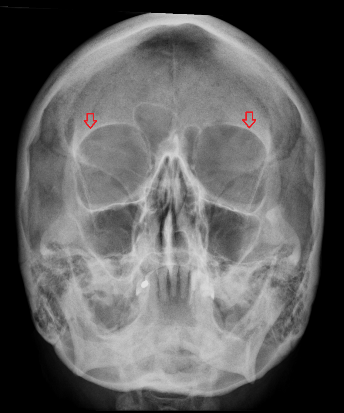 X ray Superciliary arch