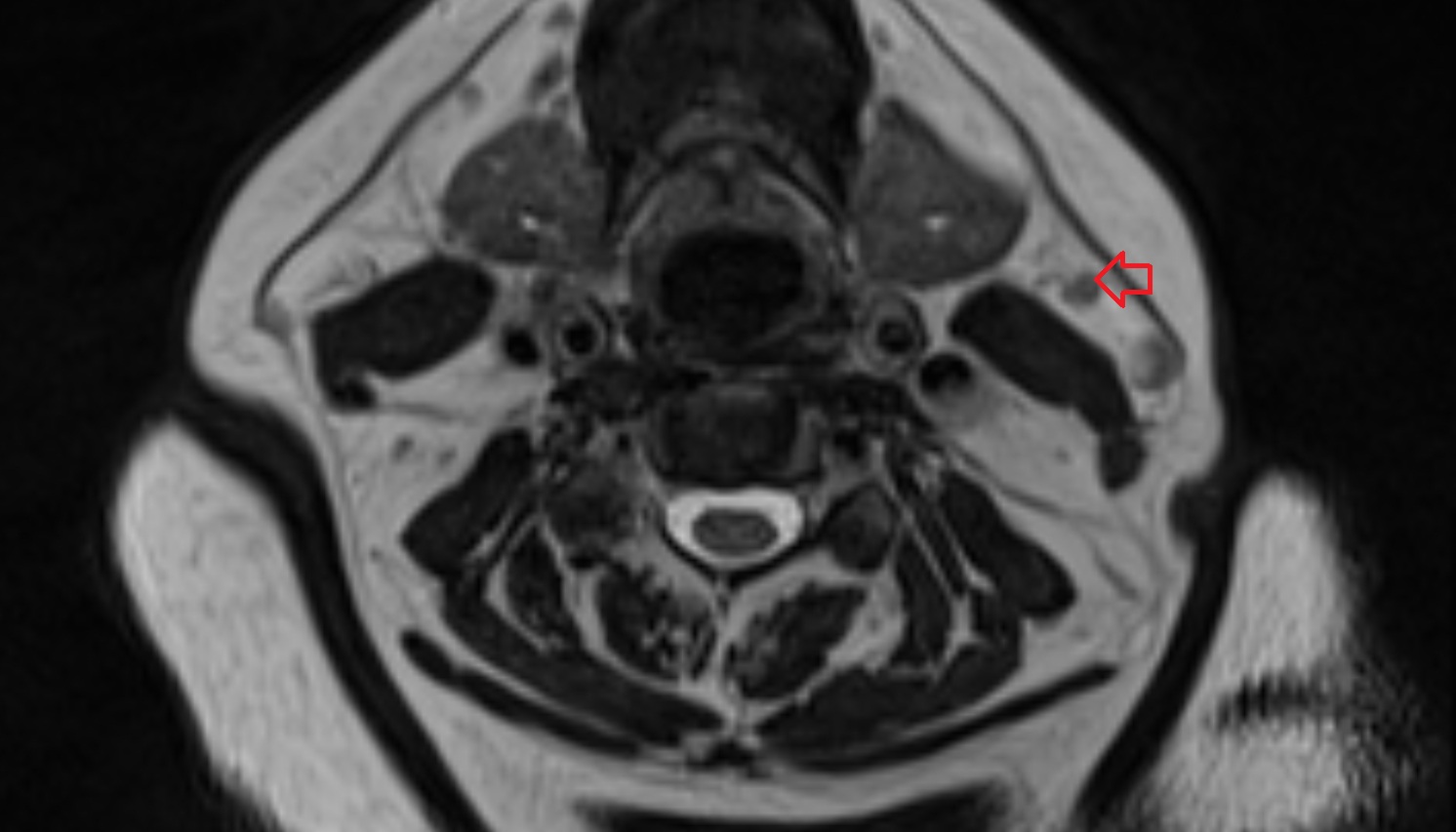Superficial Lateral Cervical Lymph Nodes  mri axial  image -img-00000-00000