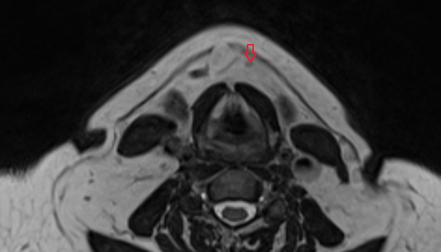 Superficial anterior cervical lymph nodes  mri axial  image -img-00000-00000