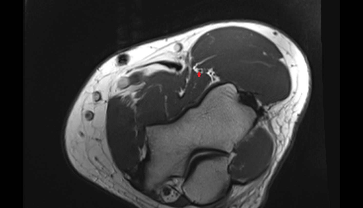 Superficial branch of radial nerve  axial cross sectional anatomy 3T MRI AI enhanced radiology image -img-00000-00000