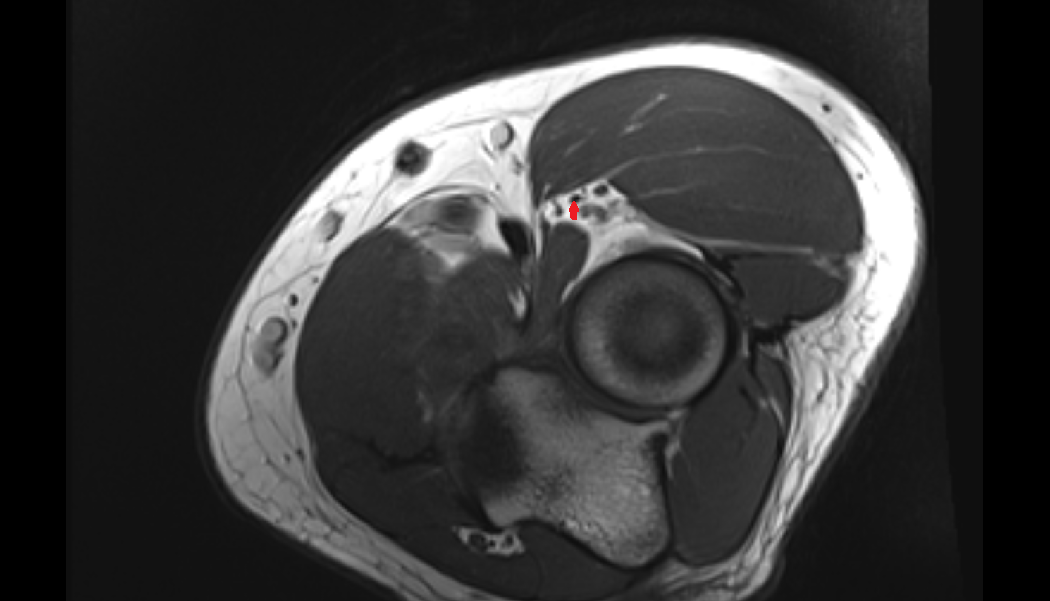 Superficial branch of radial nerve  axial cross sectional anatomy 3T MRI AI enhanced radiology image -img-00000-00000_00001