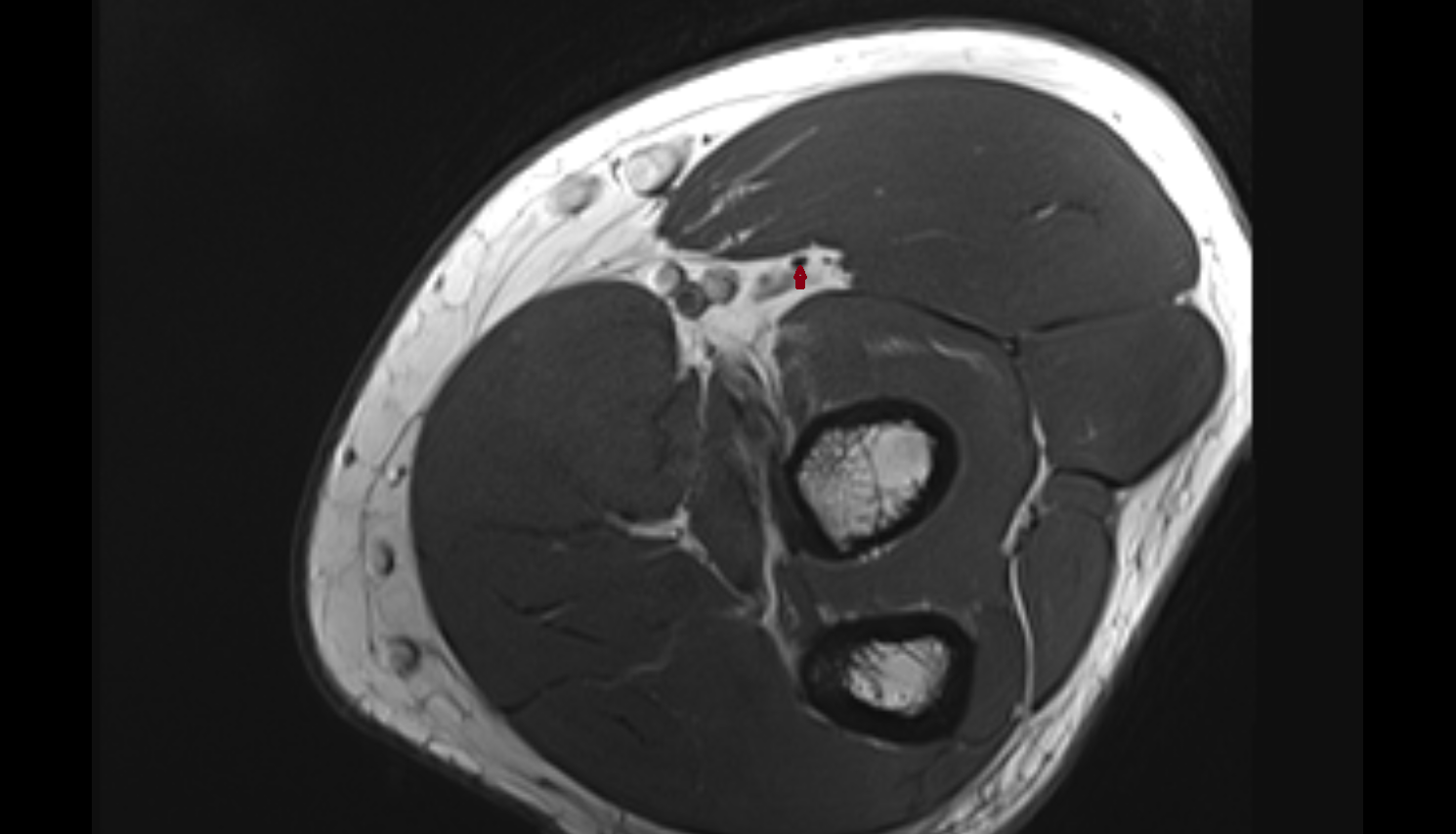 Superficial branch of radial nerve  axial cross sectional anatomy 3T MRI AI enhanced radiology image -img-00000-00000_00002