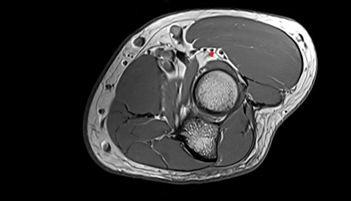 Superficial branch of radial nerve  axial cross sectional anatomy 3T MRI AI enhanced radiology image -img-00000-00000_00003