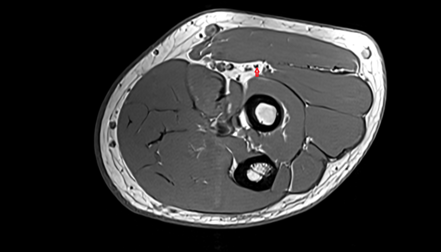 Superficial branch of radial nerve  axial cross sectional anatomy 3T MRI AI enhanced radiology image -img-00000-00000_00004