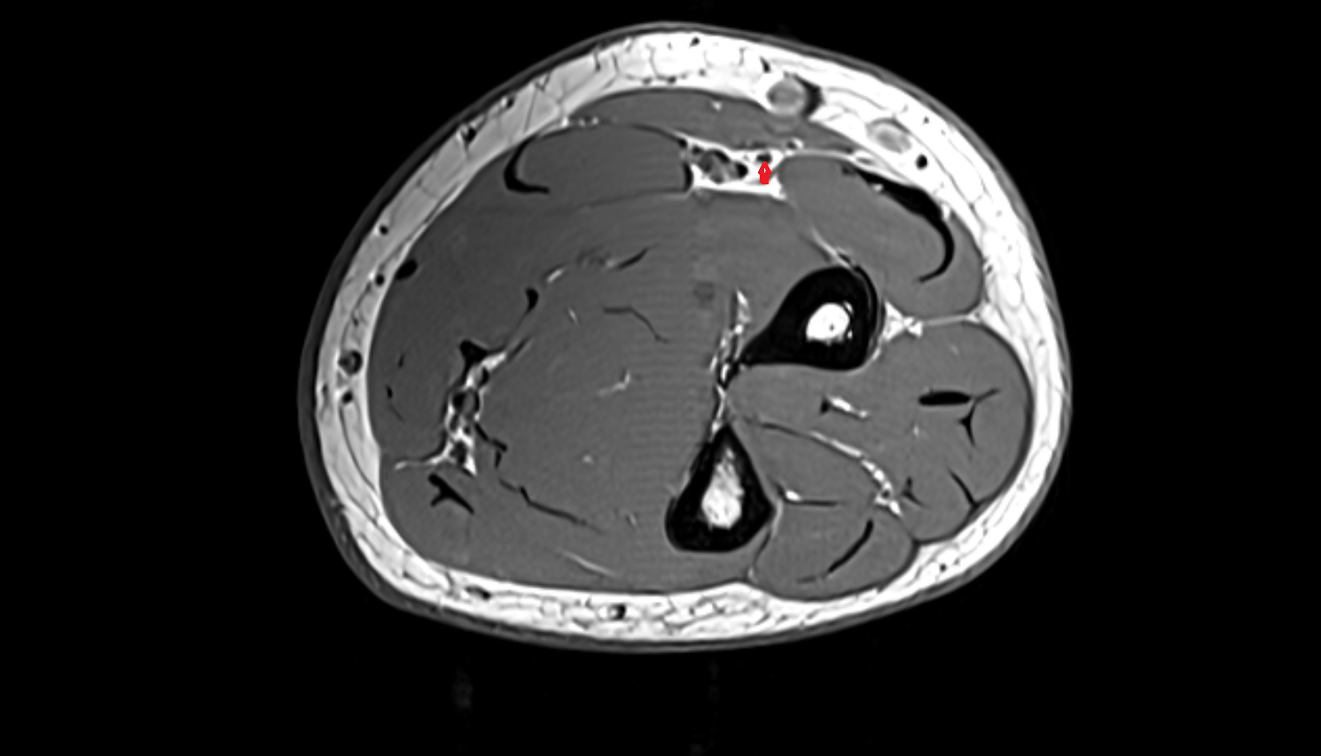 Superficial branch of radial nerve  axial cross sectional anatomy 3T MRI AI enhanced radiology image -img-00000-00000_00005
