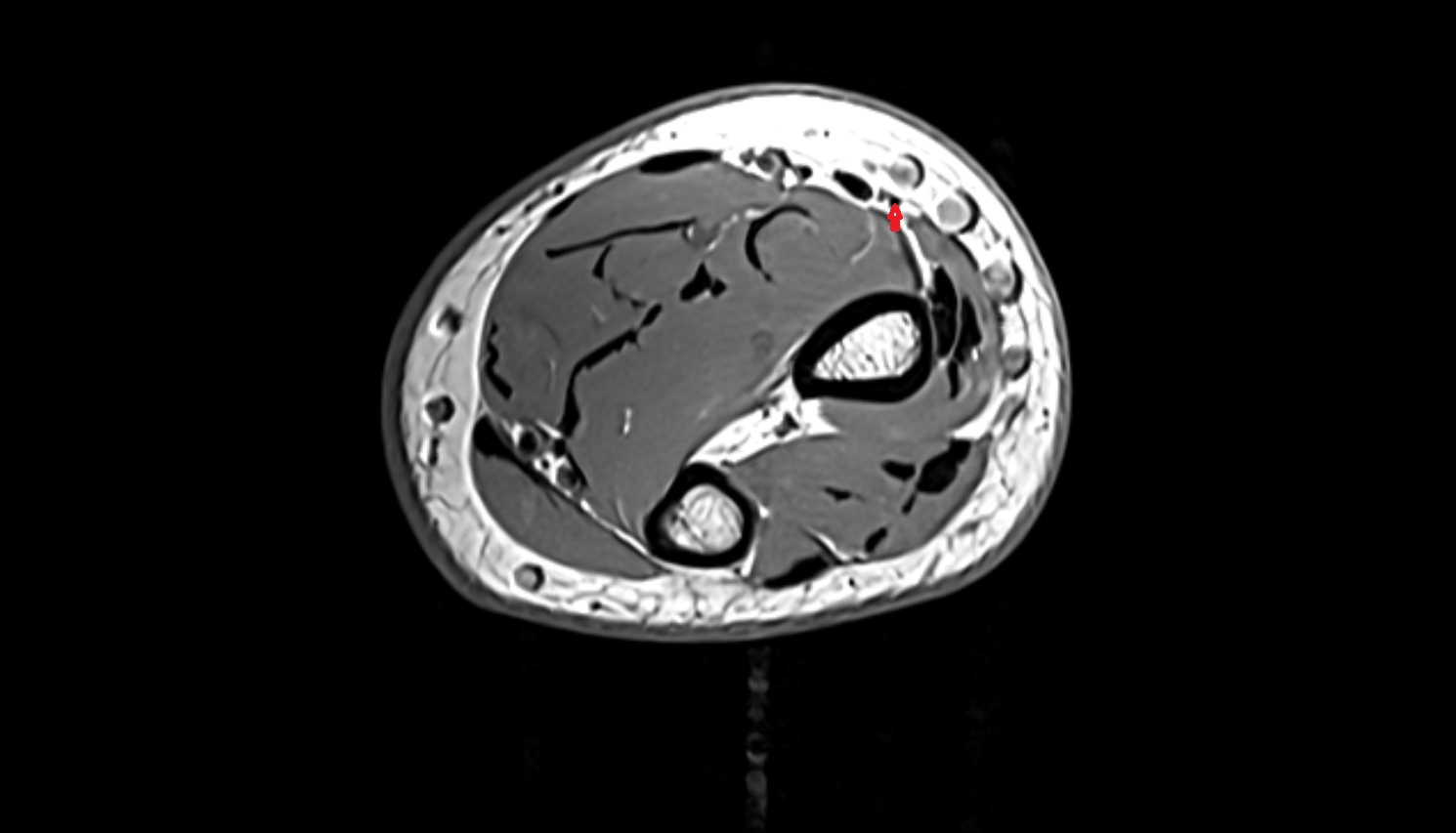 Superficial branch of radial nerve  axial cross sectional anatomy 3T MRI AI enhanced radiology image -img-00000-00000_00006