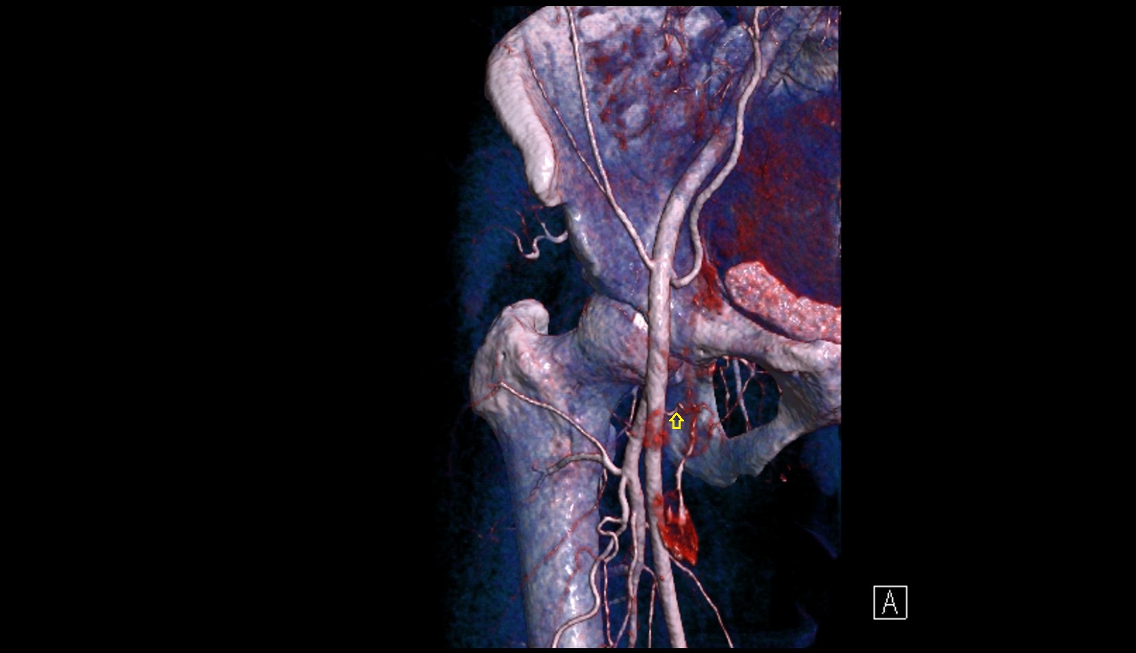Superficial circumflex iliac artery 3d image