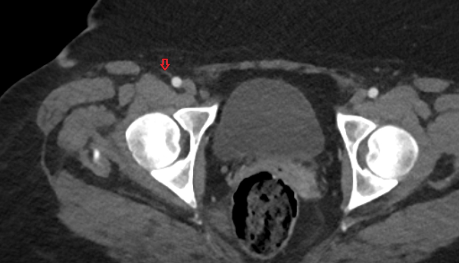 Superficial circumflex iliac artery  CT axial image  MRI  axial  anatomy  image-img-00000-00000