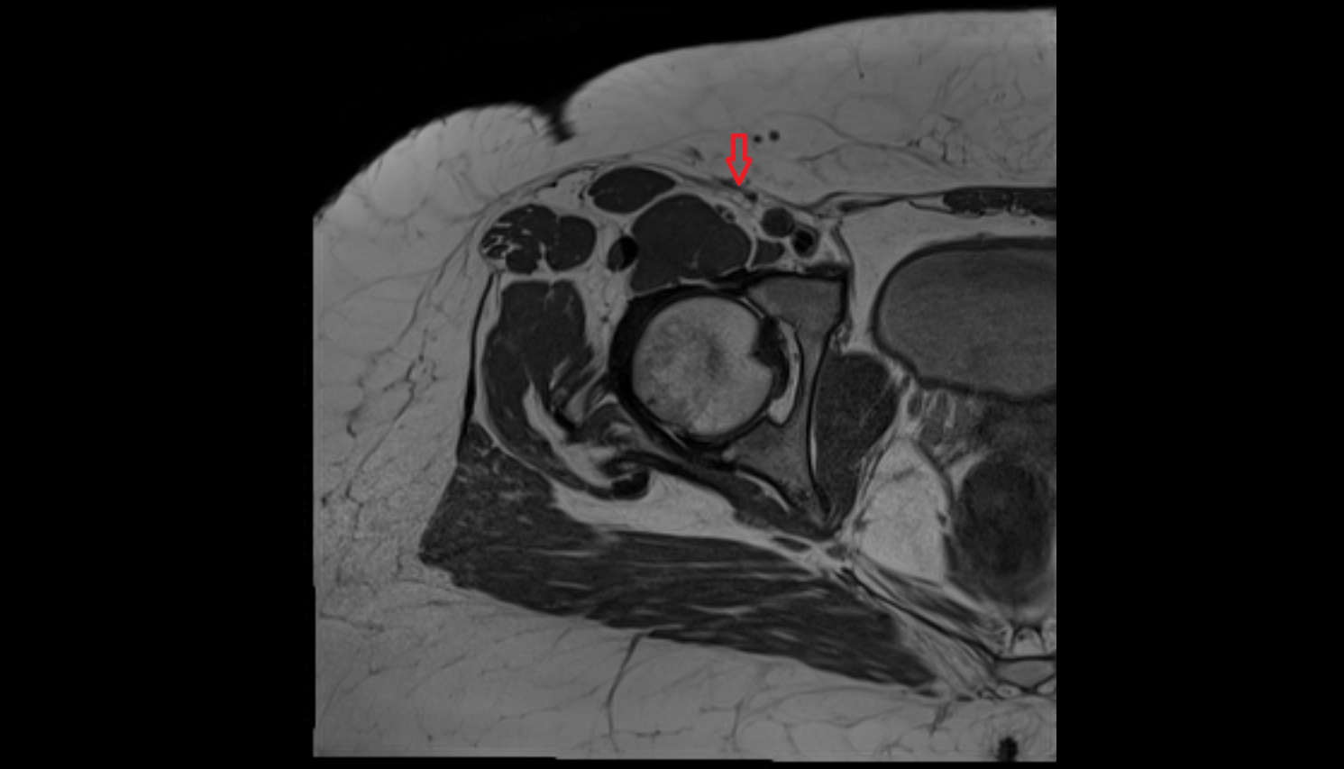 Superficial circumflex iliac artery  MRI axial image  MRI  axial  anatomy  image-img-00000-00000
