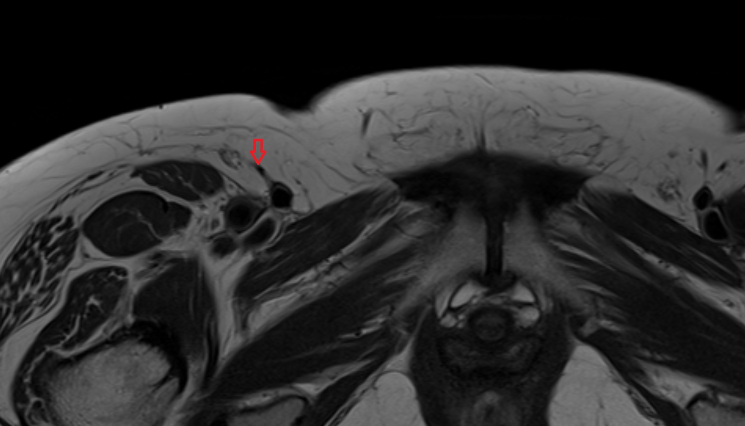 Superficial circumflex iliac vein  MRI  axial  anatomy  image-img-00000-00000