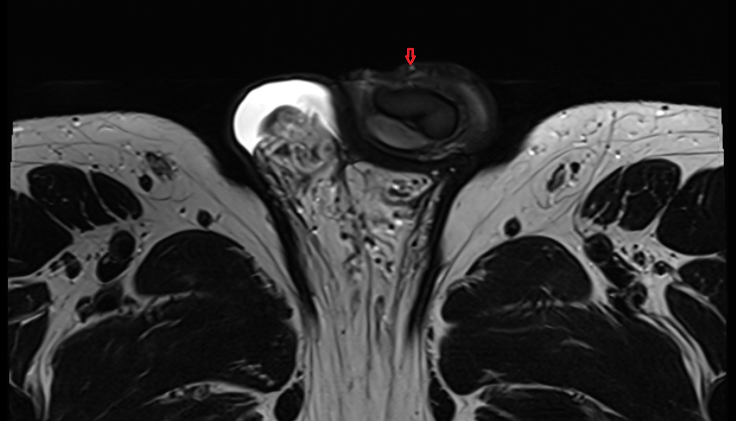 Superficial dorsal vein of penis coronal mri image