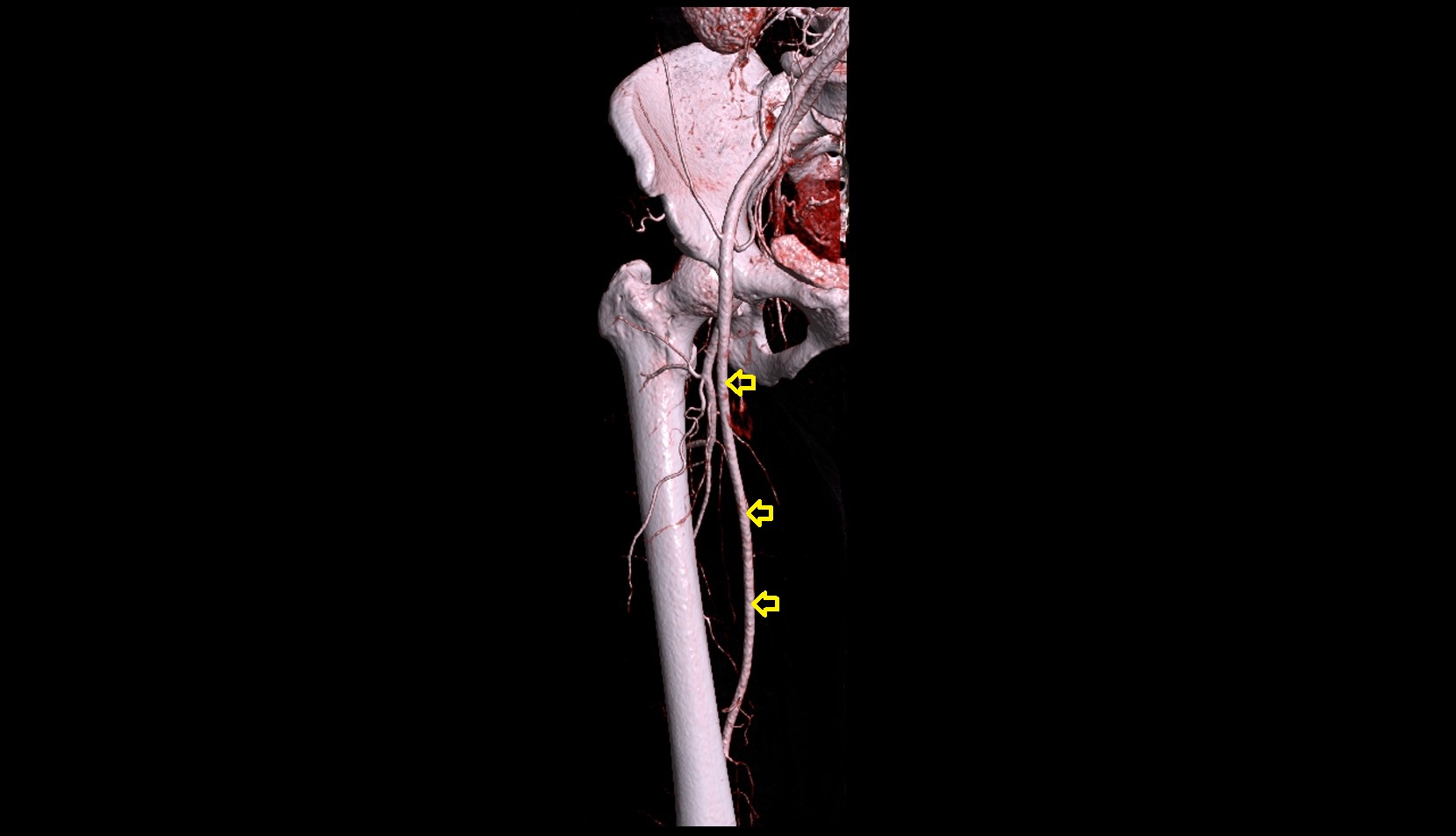 Superficial femoral artery  CT 3D VRT anatomy image