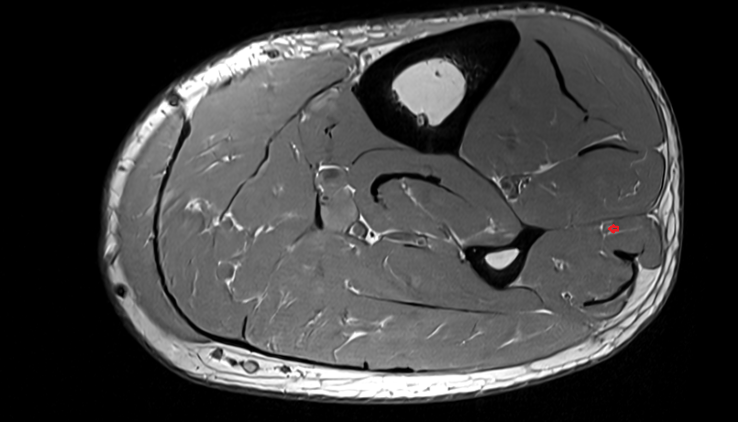 Superficial fibular nerve  axial cross sectional anatomy 3T MRI AI enhanced radiology image-img-00000-00000
