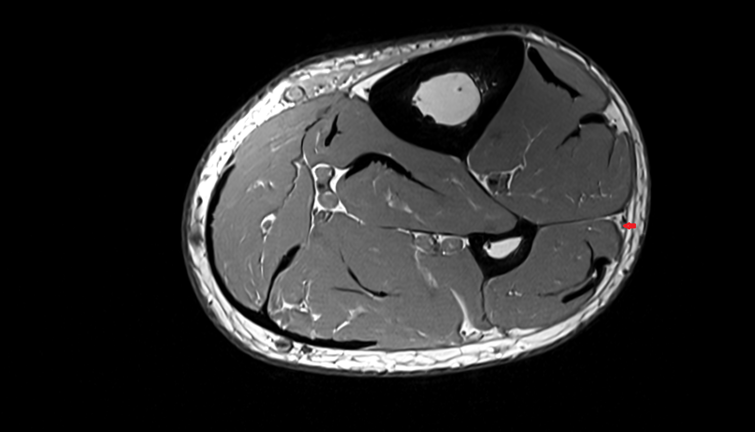Superficial fibular nerve  axial cross sectional anatomy 3T MRI AI enhanced radiology image-img-00000-00000_00001