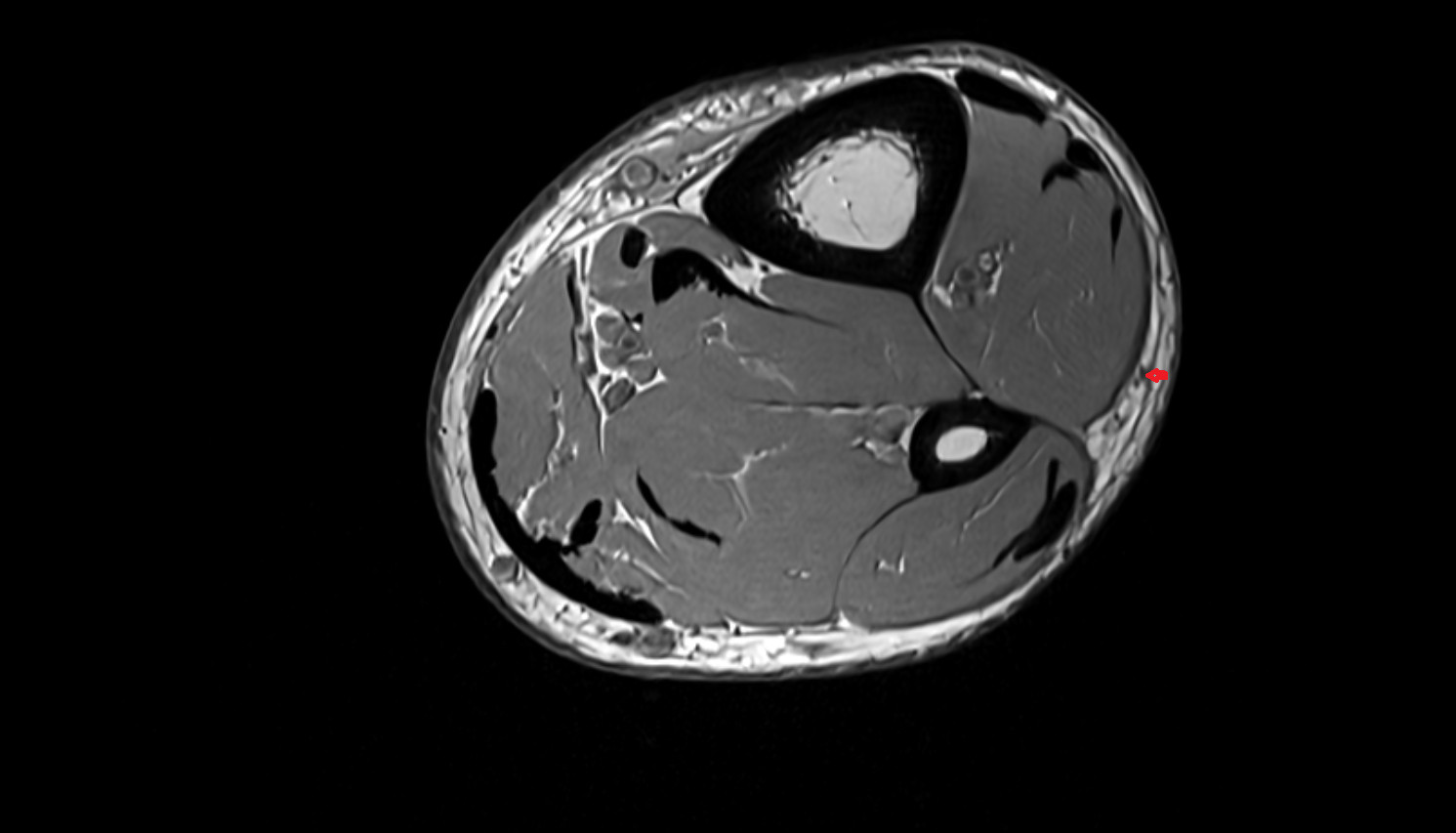 Superficial fibular nerve  axial cross sectional anatomy 3T MRI AI enhanced radiology image-img-00000-00000_00002