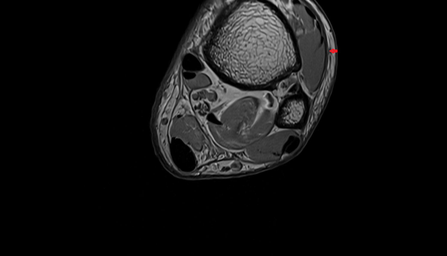 Superficial fibular nerve  axial cross sectional anatomy 3T MRI AI enhanced radiology image-img-00000-00000_00003