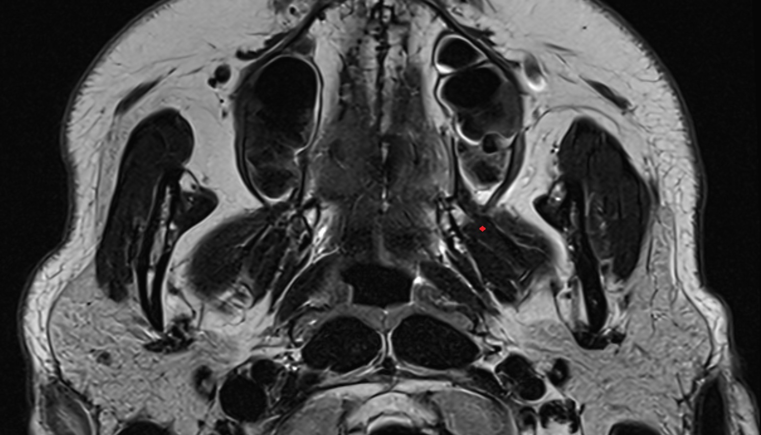 Superficial head of medial pterygoid muscle  mri axial image -img-00000-00000