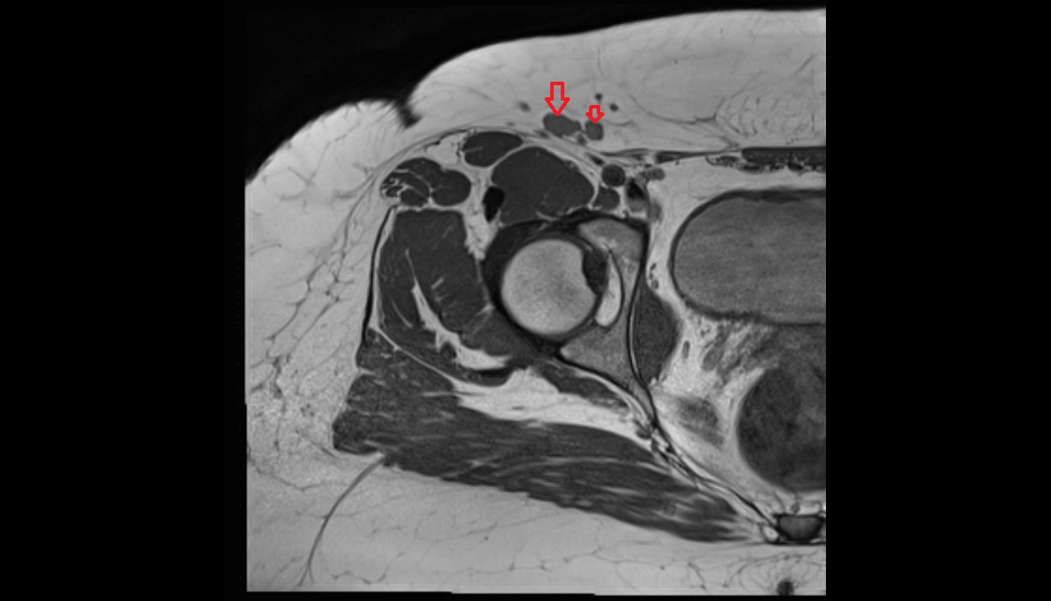 Superficial inguinal lymph nodes  MRI axial anatomy image 0