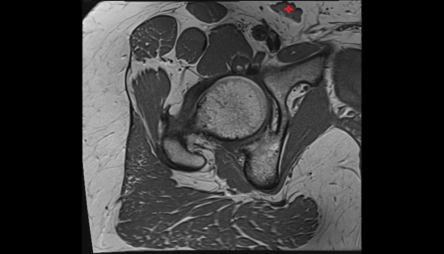 Superficial inguinal lymph nodes  MRI axial anatomy image3