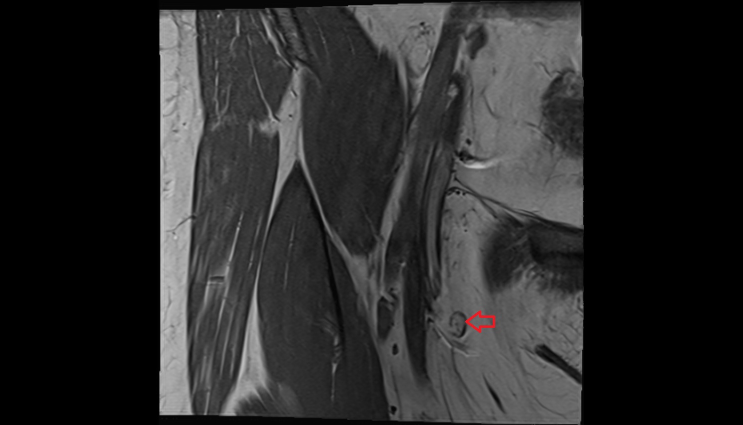 Superficial inguinal lymph nodes  MRI coronal anatomy image-img-00000-00000