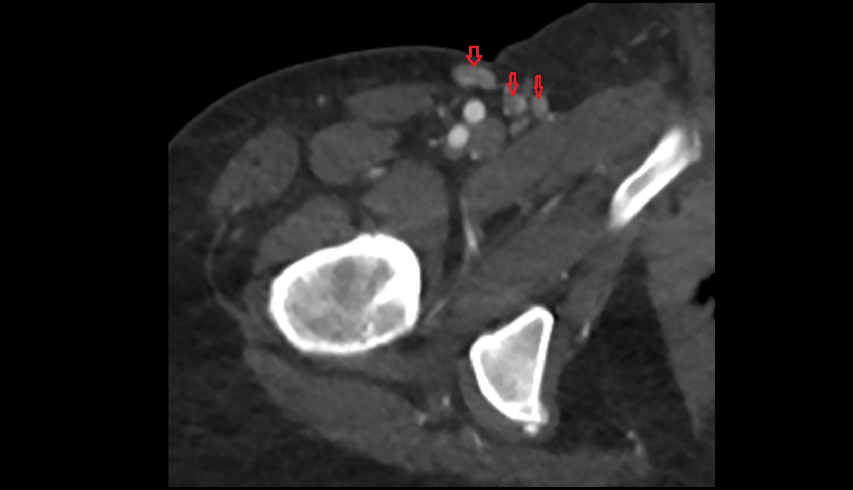 Superficial inguinal lymph nodes ct axial image