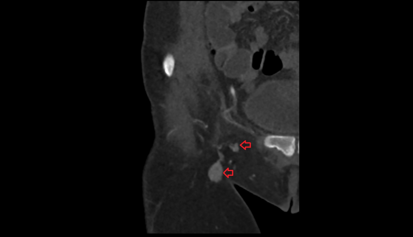 Superficial inguinal lymph nodes ct coronal image
